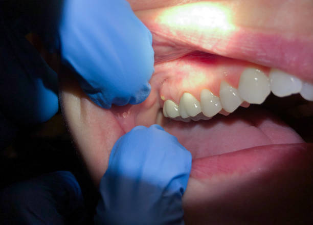 Best Emergency Treatment for Dental Infections or Abscesses in New Paris, IN